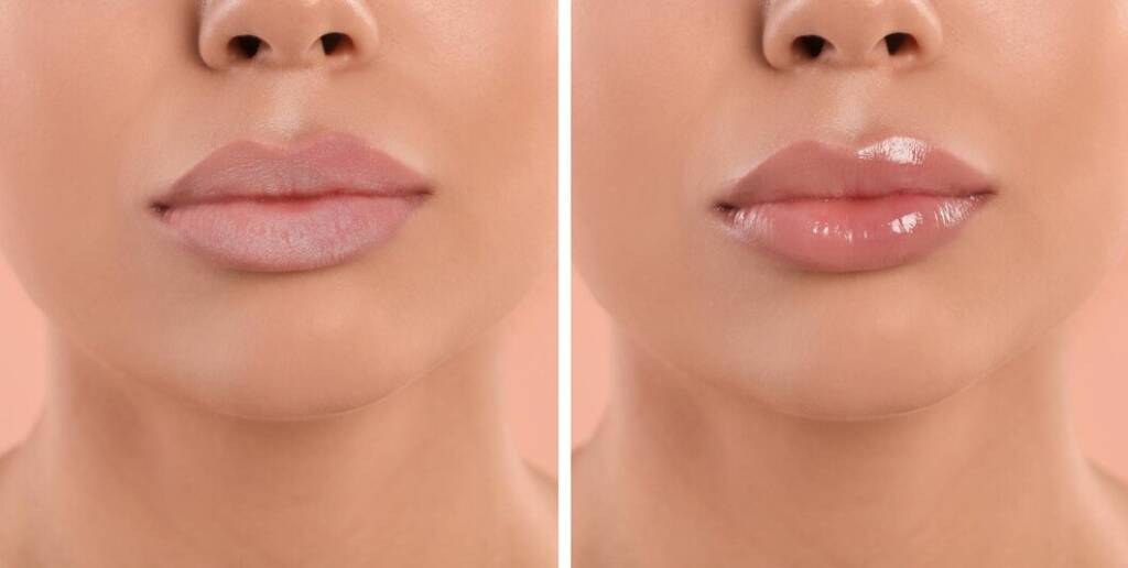Lip Filler Before and After